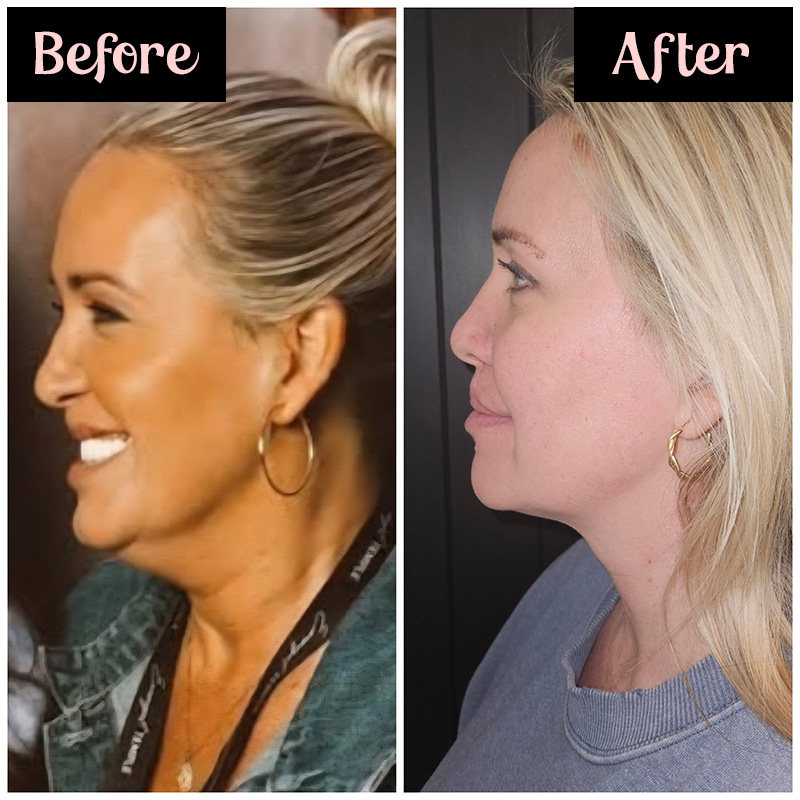 Side-by-side profile images of a woman before and after InMode Define treatments. The left image, labeled "Before," shows her smiling with a fuller jawline and wearing a green top with hoop earrings. The right image, labeled "After," shows a more contoured jawline and smoother skin tone, with the woman wearing a grey top and the same earrings. Her expression is neutral, highlighting the results of the treatment.