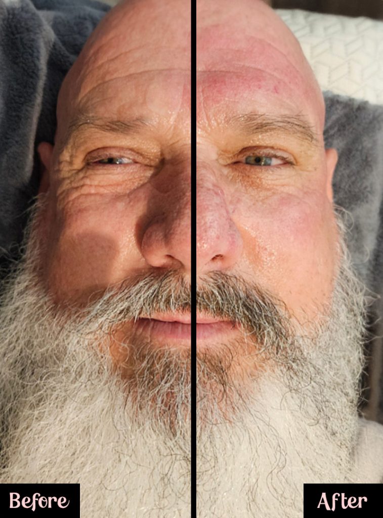 Side-by-side comparison of a man's face during a microneedling treatment. The left half, labeled "Before," shows deeper wrinkles and uneven skin texture. The right half, labeled "After," reveals smoother, more hydrated skin with a noticeable reduction in redness and fine lines. The image is split down the center to highlight the transformation.