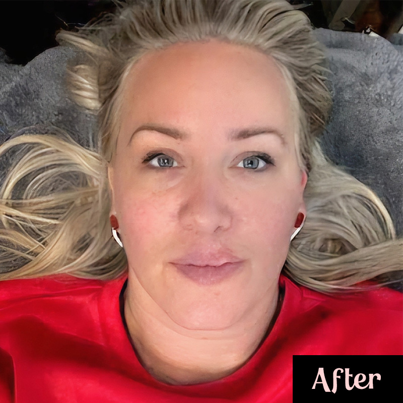 A woman with blonde hair lies on a treatment table, looking directly at the camera after a microneedling procedure. Her skin appears smoother and more even-toned, with a subtle glow. She is wearing a red top, and the word "After" is labeled in the bottom right corner of the image.