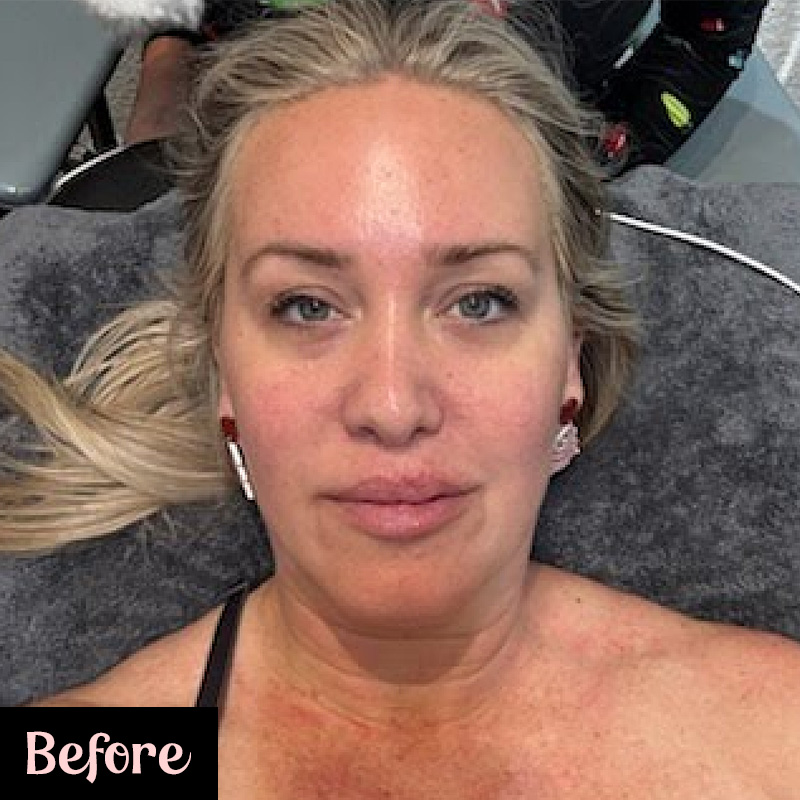 A woman with blonde hair lies on a treatment table, looking directly at the camera before a microneedling procedure. Her skin appears bare and slightly flushed. The word "Before" is labeled in the bottom left corner of the image.